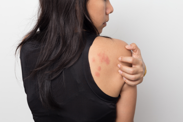 Rashes, Hives, and Eczema: Unraveling the Itch - Rocky Mount Urgent ...